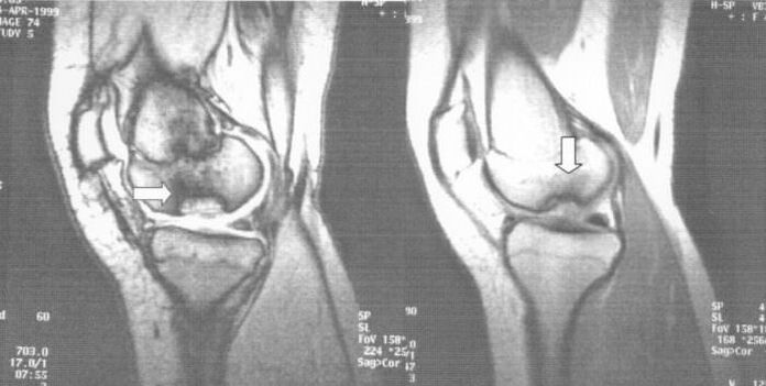 Radiografia de osteocondrită disecă în articulația genunchiului