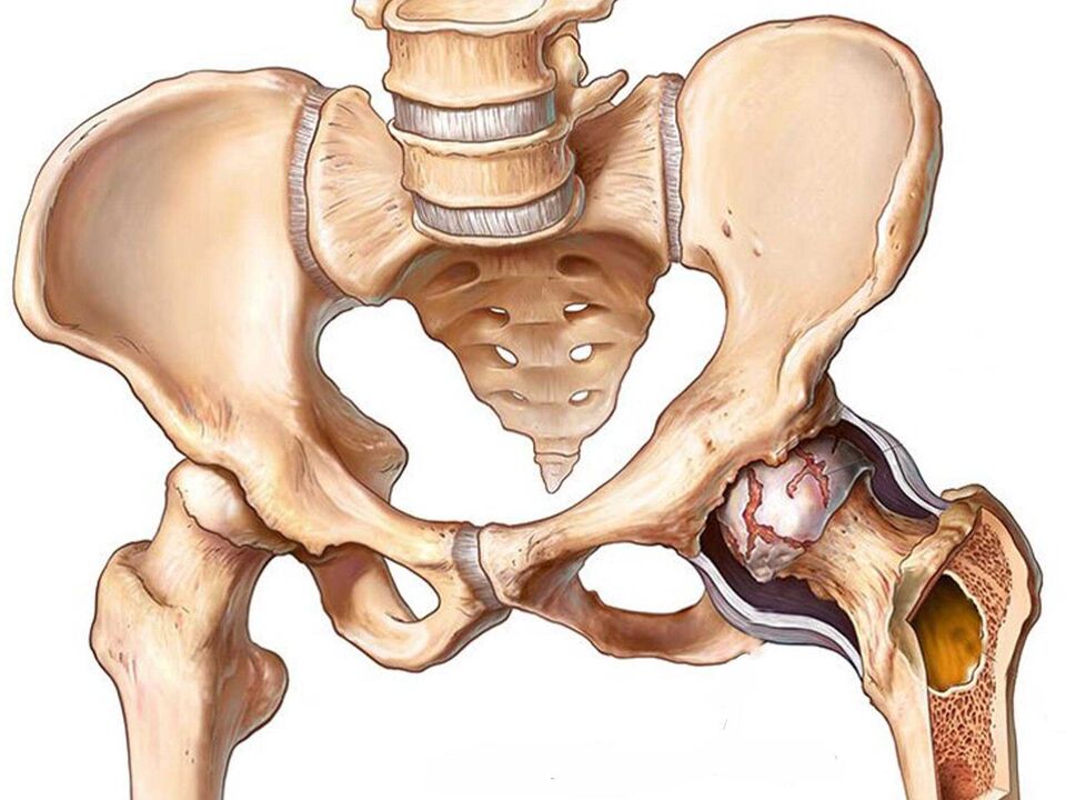 Osteoartrita articulației șoldului