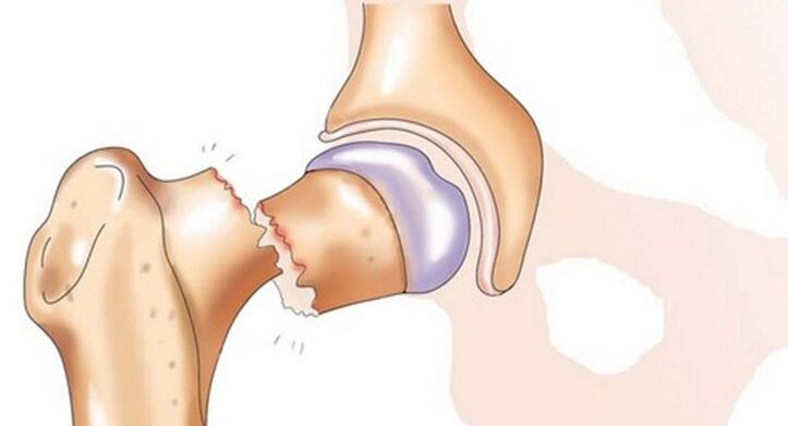 O fractură a colului femural este asociată cu dureri severe la nivelul articulației șoldului