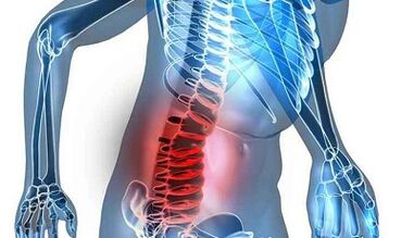 Semnele și simptomele osteochondrozei lombare