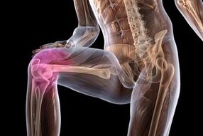 Dureri articulare din cauza osteoartritei genunchiului