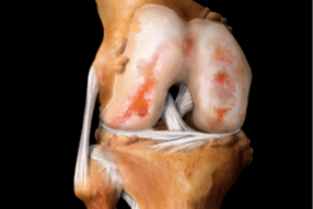 Leziuni ale articulației genunchiului din cauza osteoartritei