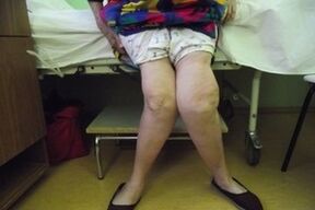 osteoartrita avansată a articulației genunchiului